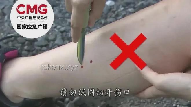 三亚女子被咬身亡救治案例研究：未提蛇咬成关键细节